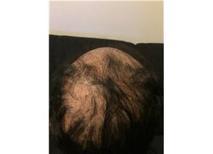 Skarlı Saç Kıran (Alopesi Areata) Nasıl Tedavi Edilir?