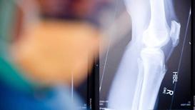 Robot yardımıyla diz ve kalça ameliyatı daha güvenli