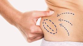 Liposuction hakkında bilmeniz gereken 5 şey