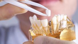 4 implant ile sağlıklı dişler