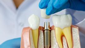 Dental implantlar başarısız olur mu?