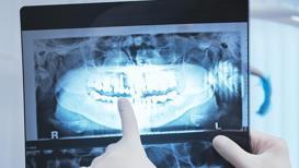 Diş röntgeni hakkında bilmeniz gereken her şey