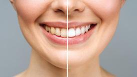 Diş sağlığınızı koruyarak beyazlatın
