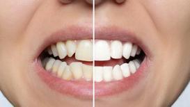 Zirkonyum dişlerde 3 önemli nokta