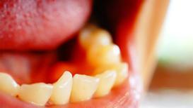 Diş travmaları: Acil durumlarda doğru müdahale
