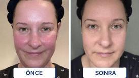 Öbek öbek çıkıyordu! Cilt kızarıklığı için tek hamle: '2 hafta bu serumu sürdüm'