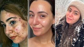 İrin akan sivilcelerinden kurtuldu! Çözümü çok basit: 'İçeriği bu asitle dolu'