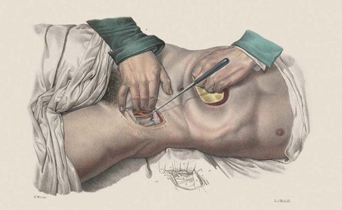 Geçmiş yüzyıllarda cerrahi müdahaleler nasıl yapılıyordu?