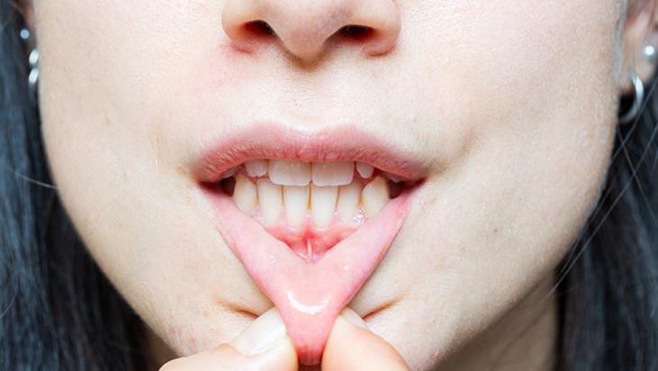 Diş eti çekiliyorsa kemik de eriyordur! Uzmanı açıkladı: Nedeni diş taşı