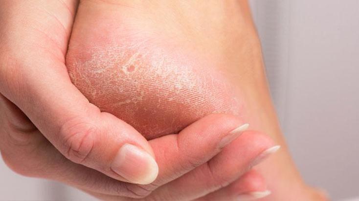 Tatilinize gölge düşmesin! Ayakları pamuk gibi yapan tek karışım