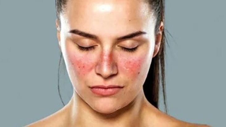 Yüzünüzdeki lekeler lupus belirtisi olabilir! Pek çok organı etkileyebiliyor