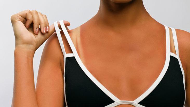 Yazın çok moda ama aslında hasar belirtisi! 'Sağlıklı bronzlaşma diye bir şey yok'