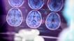 Alzheimer hastalığını erken evrede tespit edebilen kan testi!