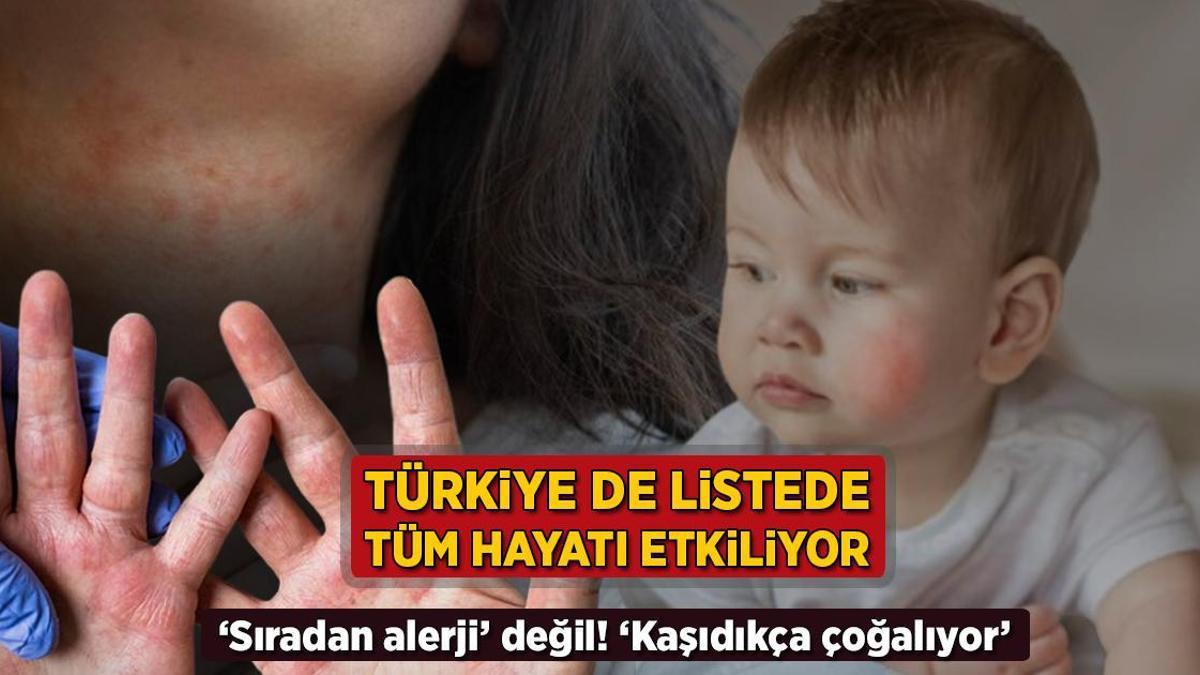Türkiye de listede, tüm hayatı kötü etkiliyor! 'Sıradan alerji' değil: 'Kaşıdıkça çoğalır'