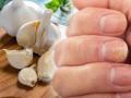 Tırnak mantarından dakikalar içinde kurtulun! 10 farklı yöntemi var: 3 damlası yetiyor