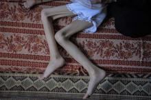 Açlık Gazzede felaket getirdi: Meryem yürüyemez duruma geldi