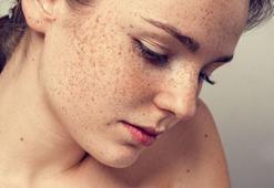Yaz aylarında artan 3 önemli cilt lekesi