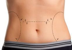 Karın germe şişmanlığın tedavisi değildir