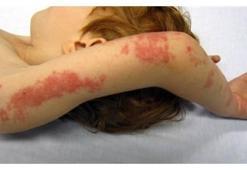 Zona hastalığı nedir