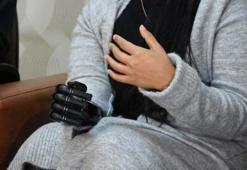 Biyonik kolu yüzünü güldürdü