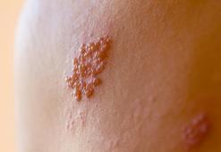 Zona hastalığı nedir, neden olur?