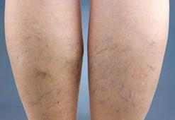 Varis ameliyatının yan etkileri nelerdir?