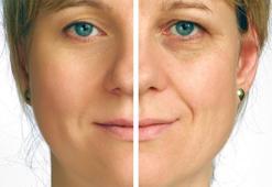 Yazın oluşan güneş lekeleri nasıl geçer?