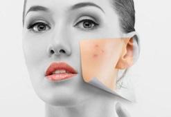 Cilt lekeleri nasıl geçer?