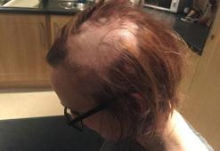 Sınav stresinden kel kaldı