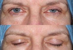 Göz kapağı düşüklüğü hastalık belirtisi mi?