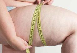 Lipodem nedir, nasıl tedavi edilir?