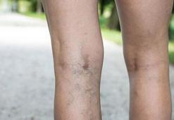 Varis tedavi edilmezse ne olur?