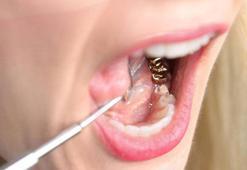 İmplant sonrası dikkat edilmesi gerekenler