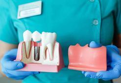 İmplant yaptırmadan önce bilinmesi gereken 6 şey
