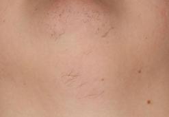 Tüylenme yaşıyorsanız mutlaka yapın! - Tüylenme için hangi doktora gidilmeli?