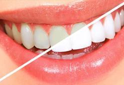 Dişlerdeki renk ve şekil bozukluğu böyle gideriliyor!