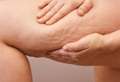 Lipödem’e dikkat! Kadınlarda sık görülüyor!