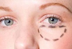 Göz altı torbaları neden olur? Ameliyatsız tedavi mümkün mü?