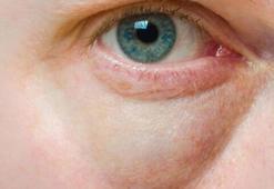 Göz altı torbalarının asıl nedeni düzensiz uyku mu?