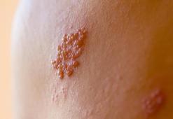 Zona Belirtileri Nelerdir? Zona Hangi Hastalığın Habercisi Olabilir?
