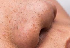 Burundaki siyah noktalar nasıl geçer? Doğal yollarla temizleme yöntemleri