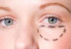 Göz altı torbaları nasıl geçer, ne iyi gelir? Göz altı torbaları nasıl giderilir, bitkisel yöntemler...