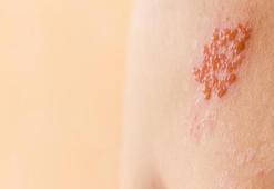 Zona hastalığı nasıl geçer, ne iyi gelir? Zona belirtileri ve tedavisi