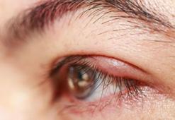 Göz kapağı şişmesi nasıl geçer? Göz şişliğine ne iyi gelir? Bitkisel yöntemler