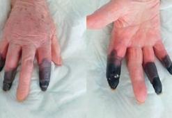 Kan dondurdu! Koronavirüs parmaklarını bu hale getirdi...