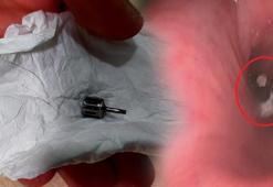 Dişçide akciğerine implant parçası kaçtı!
