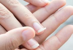 Parmakta Dolama Nasıl Olur? Dolamanın Belirtileri Ve Tedavi Yöntemleri Nelerdir?