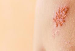 Zona Hastalığı Nedir, Neden Oluşur? Zona Bulaşıcı Mıdır?