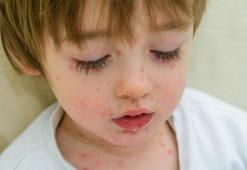 Zona Hastalığı Öldürür Mü? Zona Hastalığı Tedavi Edilmezse Ne Olur, Tehlikeli Midir?