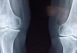 Raşitizm Hastalığı Nedir? Raşitizmin Belirtileri Nelerdir, Tedavisi Nasıl Yapılır?